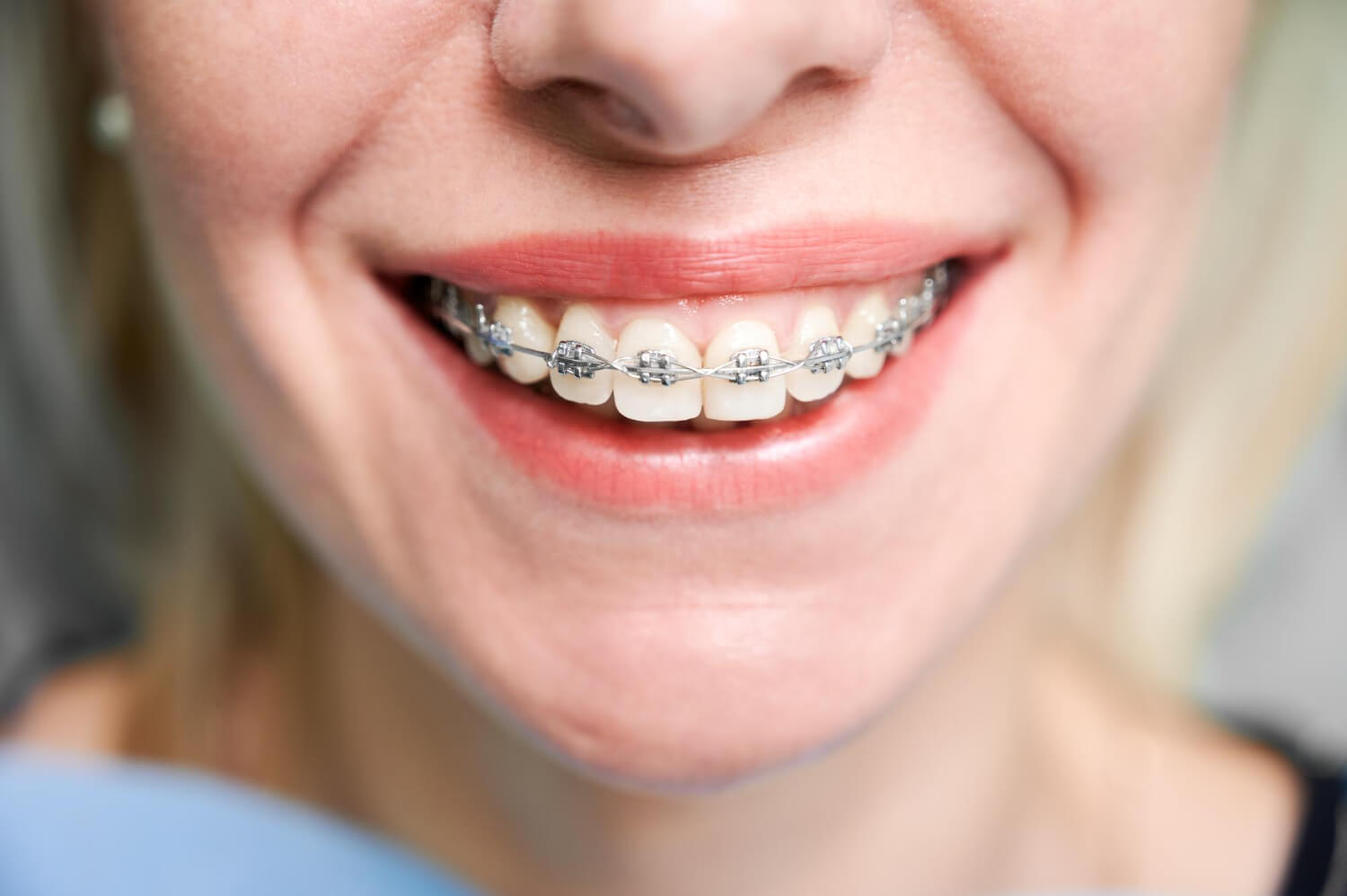 Close de sorriso com aparelho ortodôntico autoligado metálico na Smile Center em José Bonifácio, Zona Leste SP.