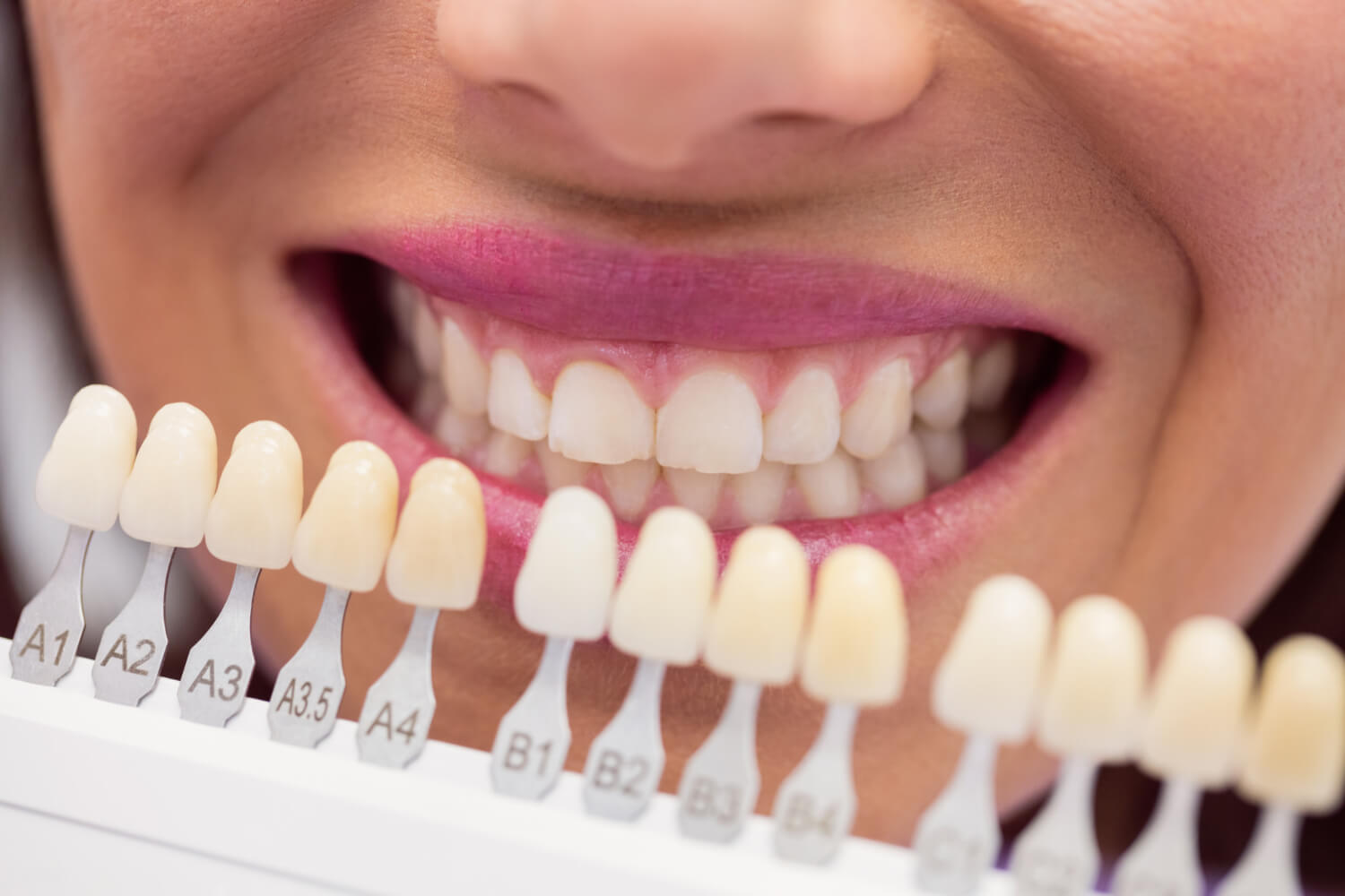 Dentista usa escala de cores de dentes para planejar facetas em porcelana na Clínica Smile Center, localizada na Zona Leste de SP.